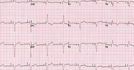 Un fraudeur à l'assurance trahi par les données de son pacemaker