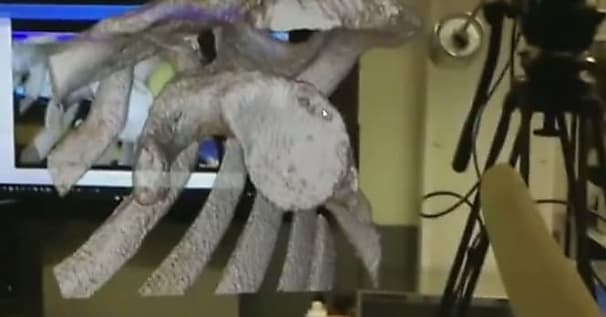 Réalité mixte à l'hôpital: Microsoft HoloLens transformée en assistant chirurgie